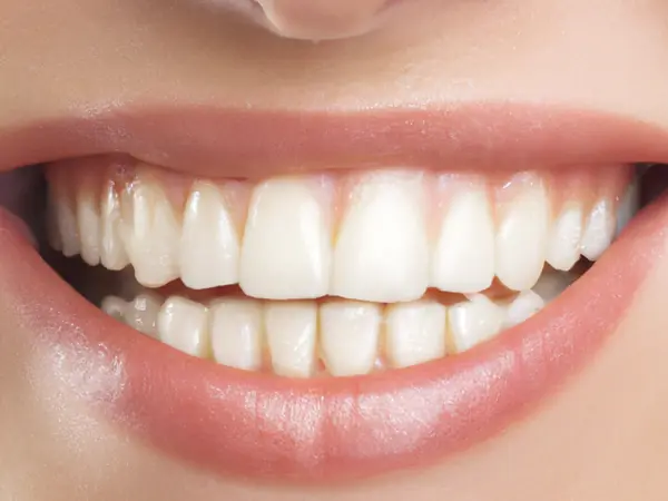 Close-up of an even, bright smile with porcelain veneers