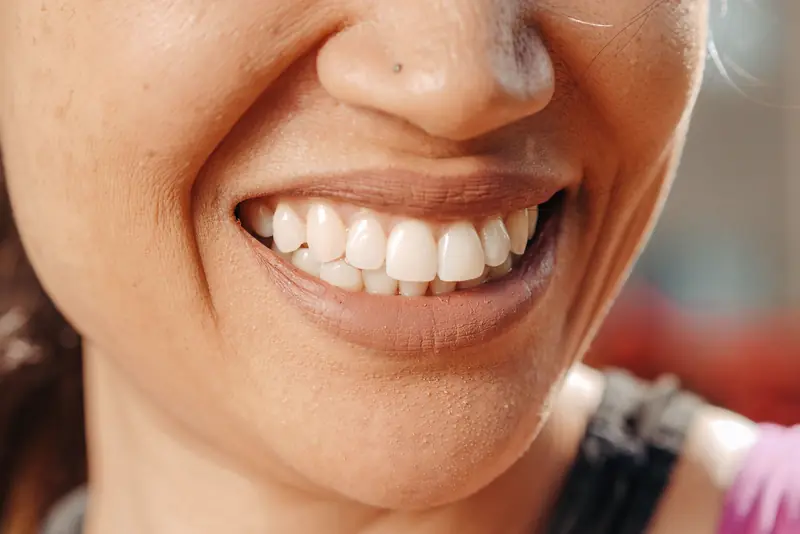 Close-up of a bright, natural smile after whitening